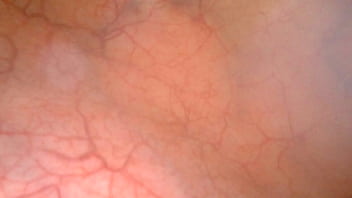 A View Of My Bladder Full Of Piss With Endoscopy thumbnail