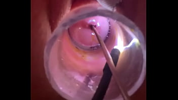 Electrosound cervix and m