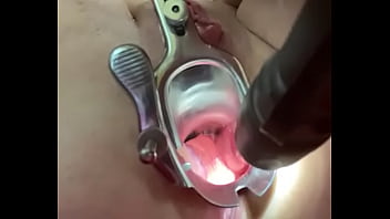 Anal speculum Anal speculum